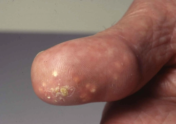 dog skin calcification